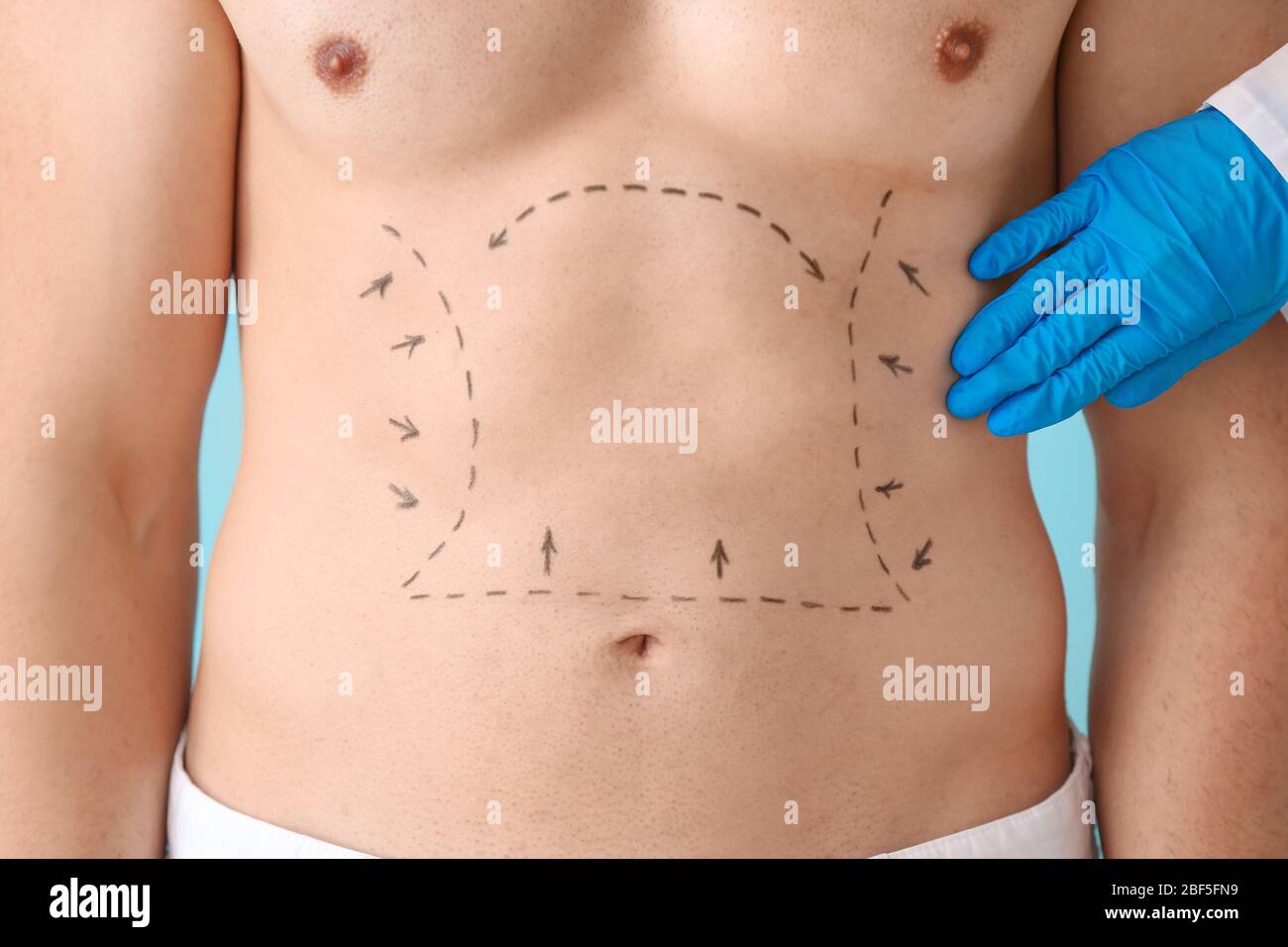 Young man with marks on his body, closeup. Concept of plastic surgery Stock  Photo - Alamy
