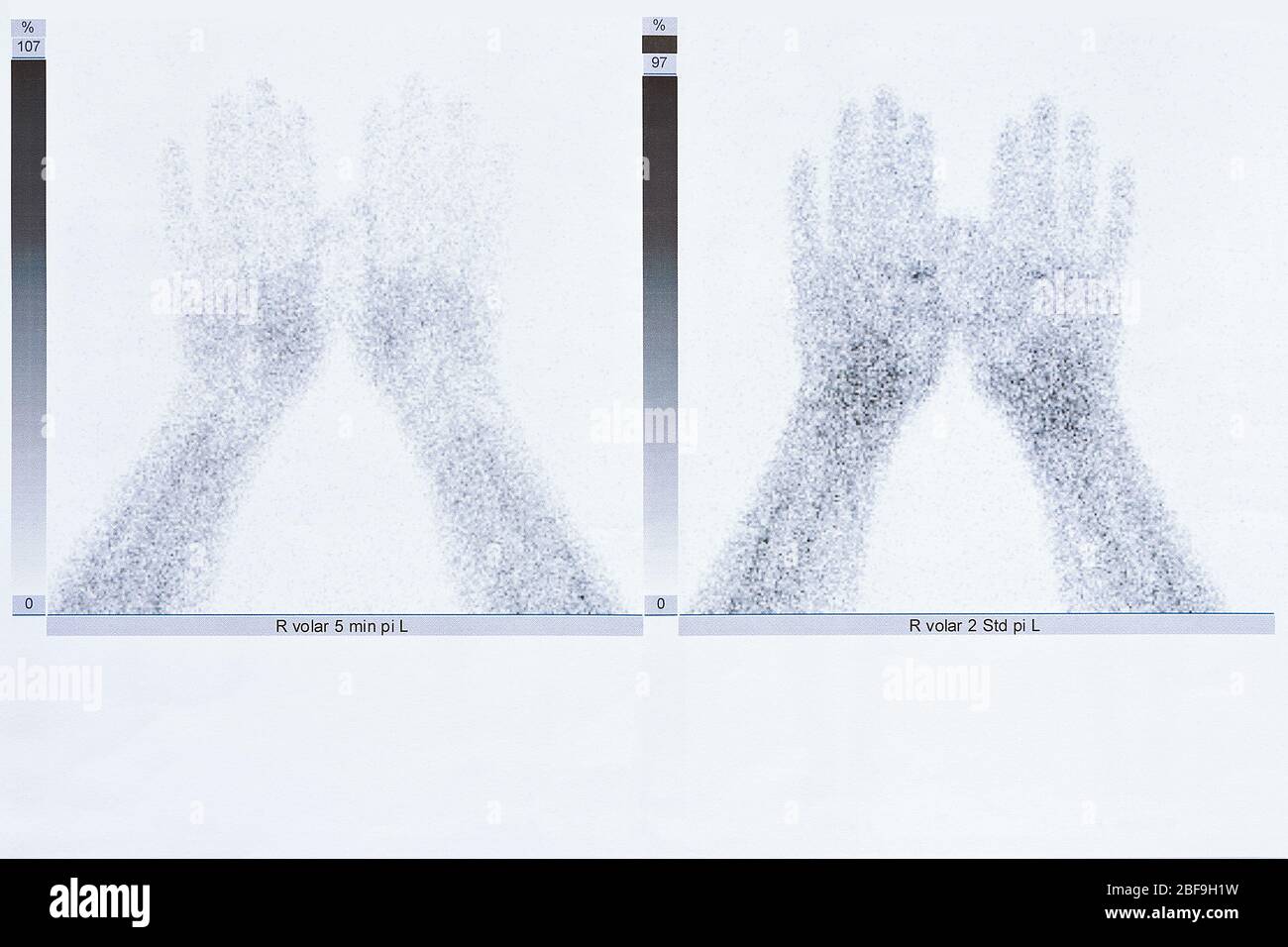 Bone scintigraphy or scintigram of the hands of a 50 year old woman, showing degenerative joint disease Stock Photo