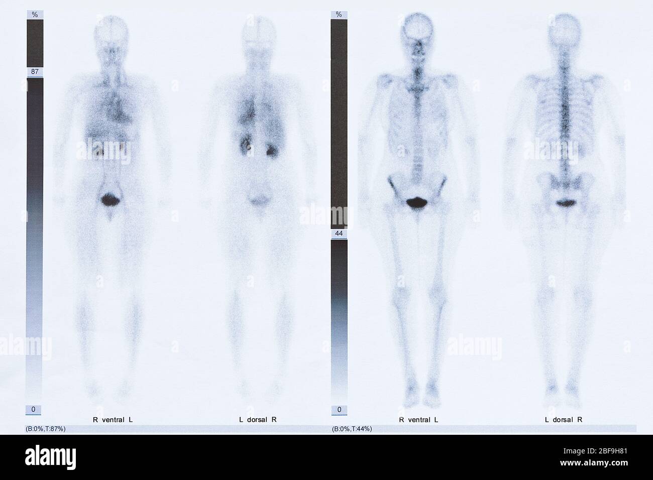 Bone scintigraphy or scintigram of the whole body of a 50 year old woman, showing arthrosis at the thoracic spine Stock Photo
