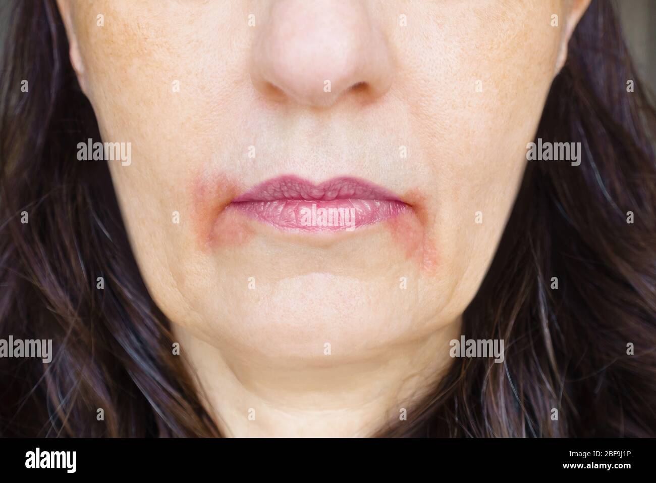 Perleche or perioral dermatitis: womans mouth with big red spots of  inflamed skin around the corners Stock Photo - Alamy