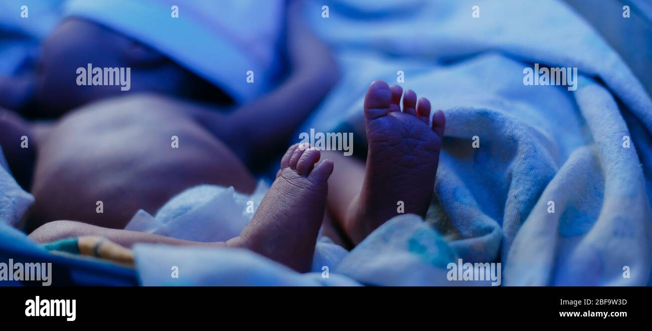 A baby newborn with elevated bilirubin lies under a blue lamp