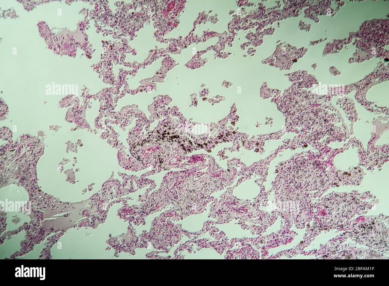 Lung tissue as dust lung under the microscope 100x Stock Photo Alamy