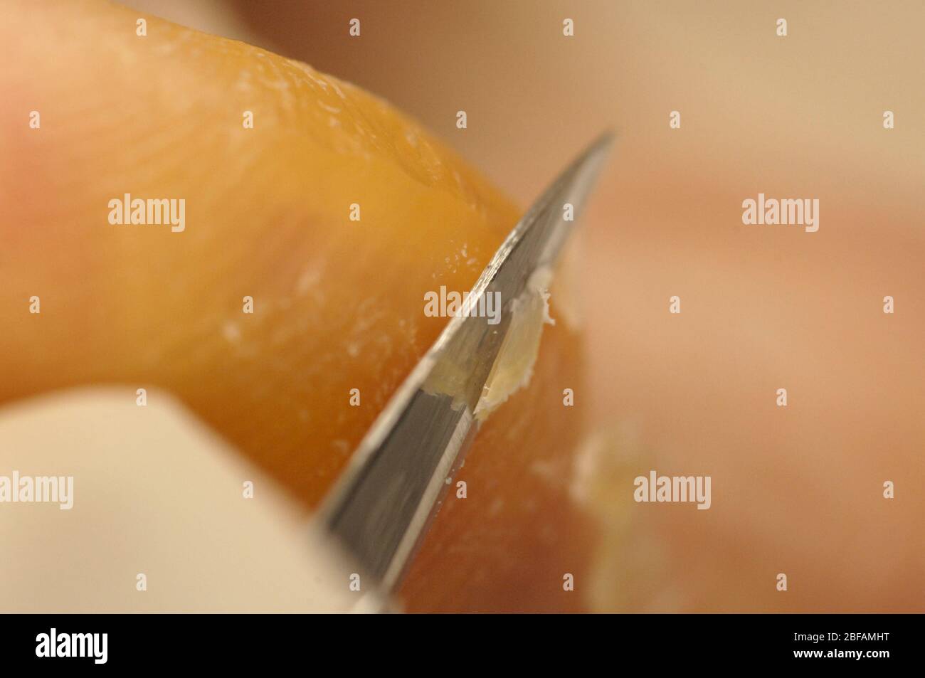 Chiropodist using a scalpel to remove hardened and calloused skin from