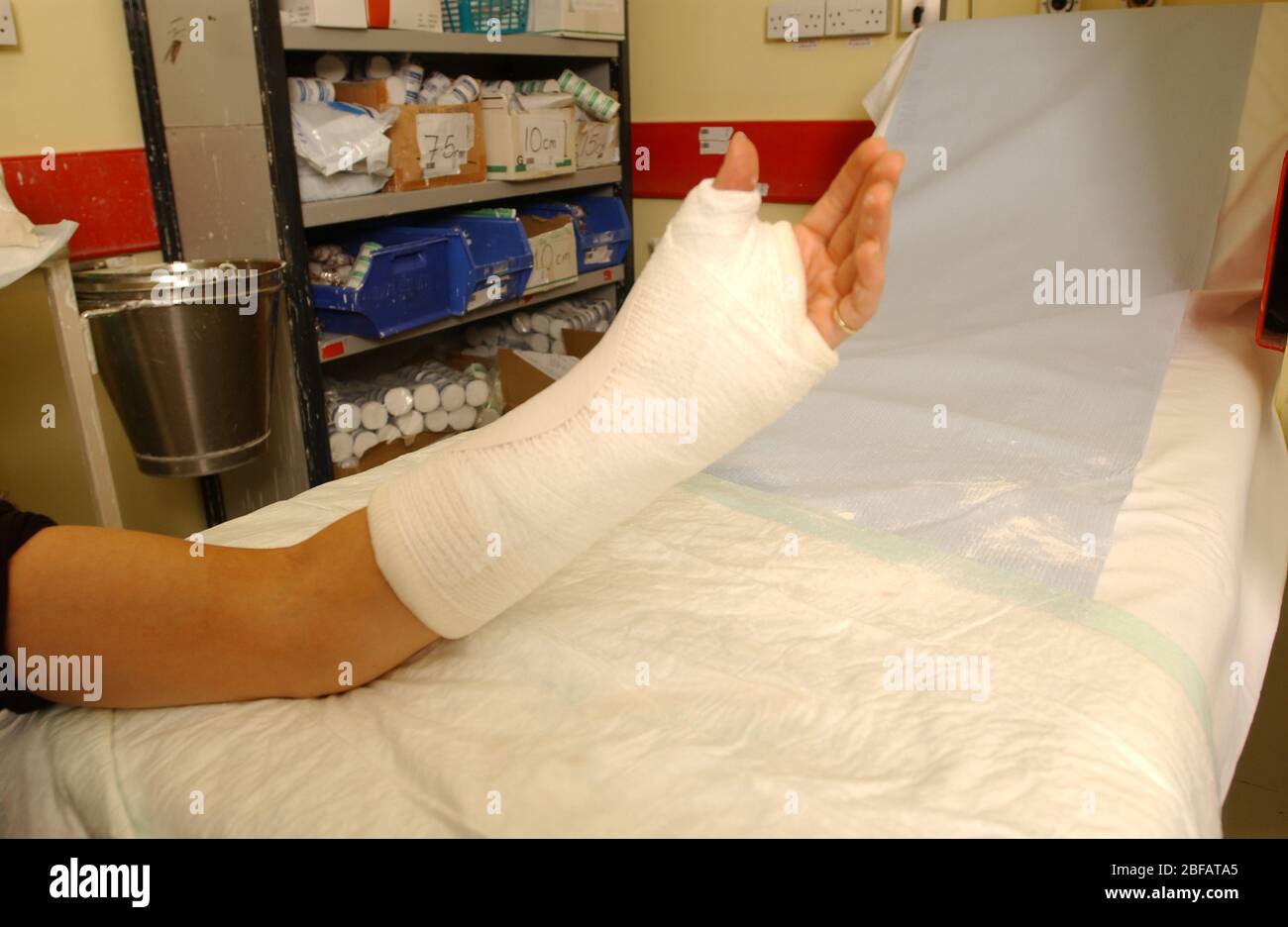 Plaster of paris cast arm hi-res stock photography and images - Alamy