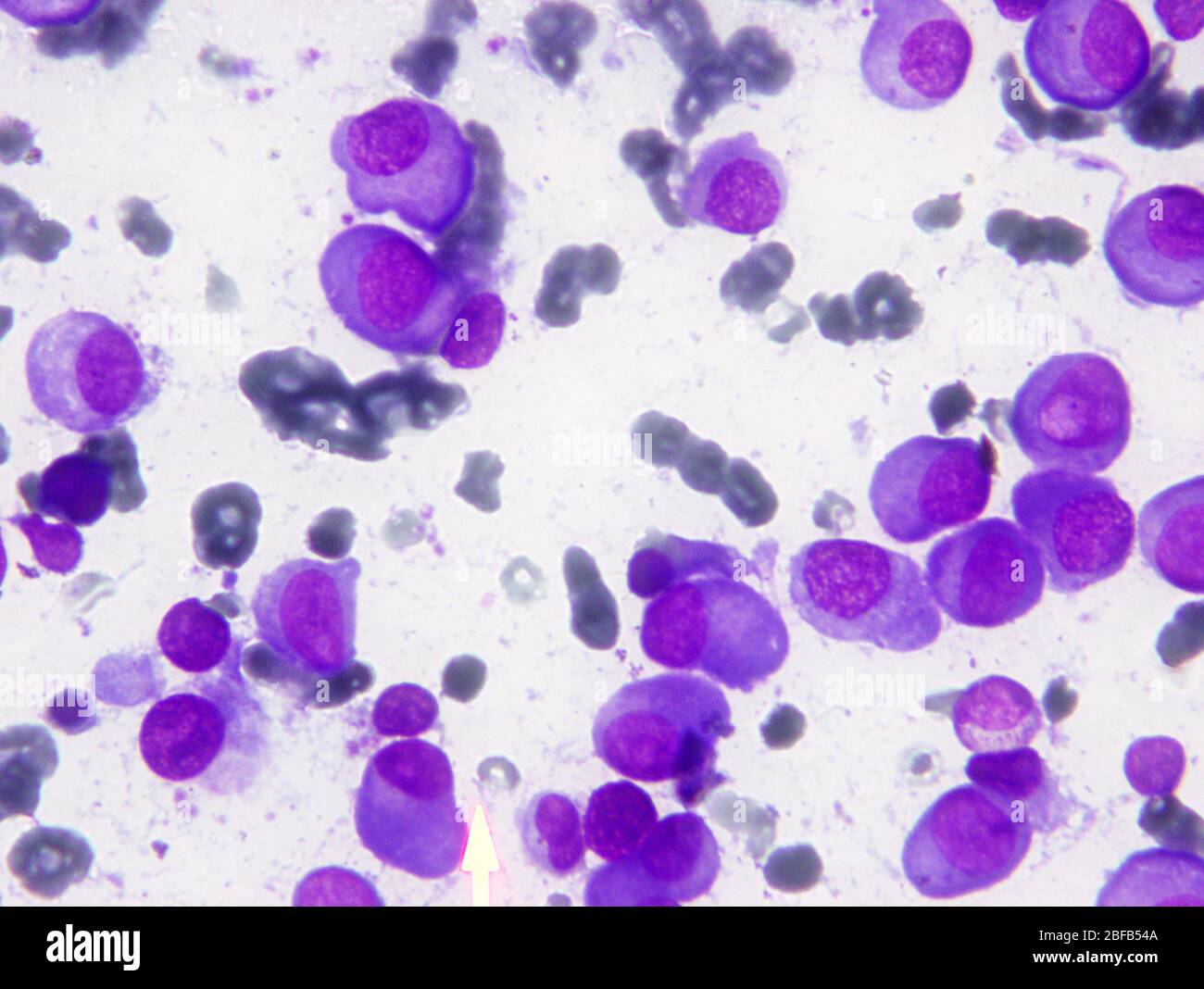 Microscopic image of Multiple Myeloma. Multiple Myeloma is type of cancer,  it occurs then a plasma cell becomes abnormal and cancerous. The cancerous  Stock Photo - Alamy