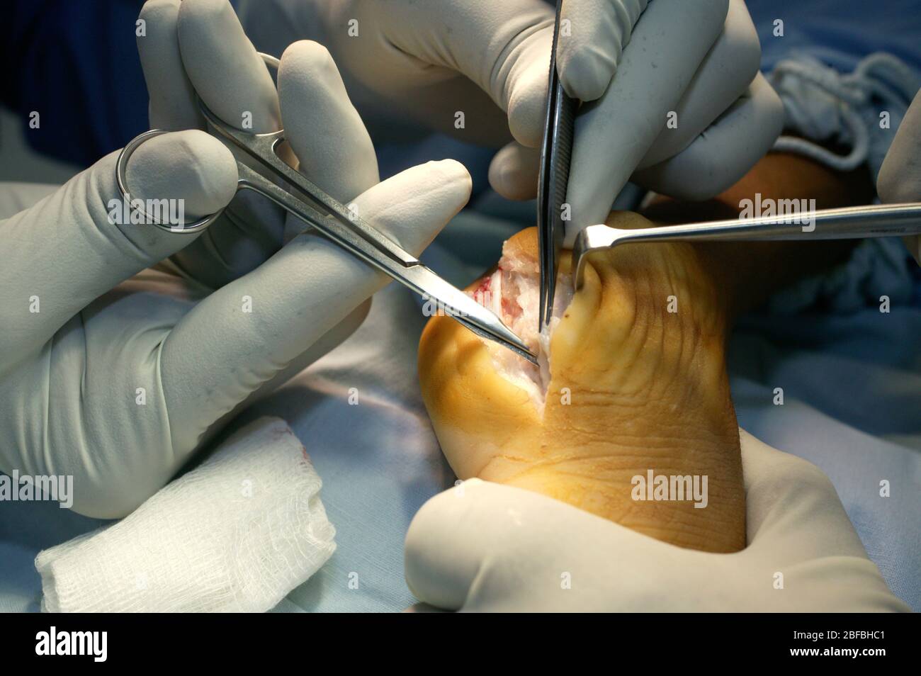 Surgeons use scissors to dissect away the soft tissue and fascia revealing the peroneus tertius tendon. Stock Photo