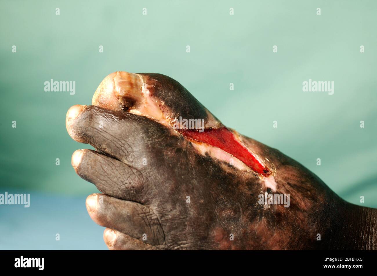 Actinomycetoma of the left foot.  Mycetoma is an uncommon disease found in the tropics. It is a chronic, localised infection of the skin and underlyin Stock Photo