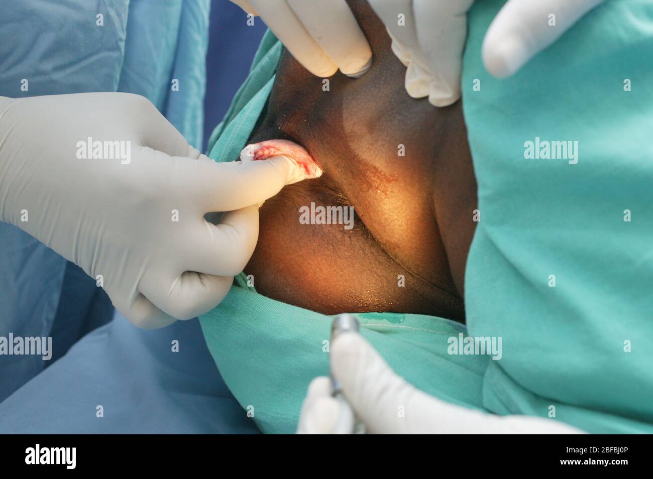 Surgeons clean the infected area of the anus, prior to surgery Stock Photo