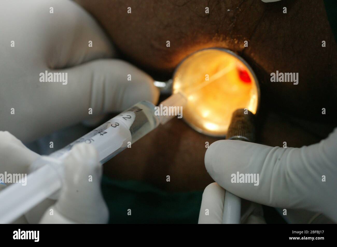 Surgeons inject a sclerotherapy agent, used as a local anaesthetic to block nerves Stock Photo