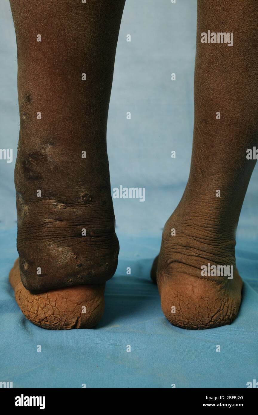 Posterior view of Eumycetoma of the left ankle.  Mycetoma is an uncommon disease found in the tropics. It is a chronic, localised infection of the ski Stock Photo
