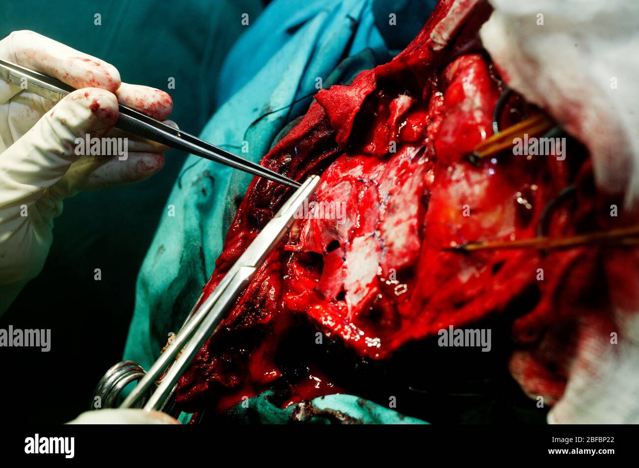 A neurosurgeon operating on a patient's brain starts to close the wound. Stock Photo