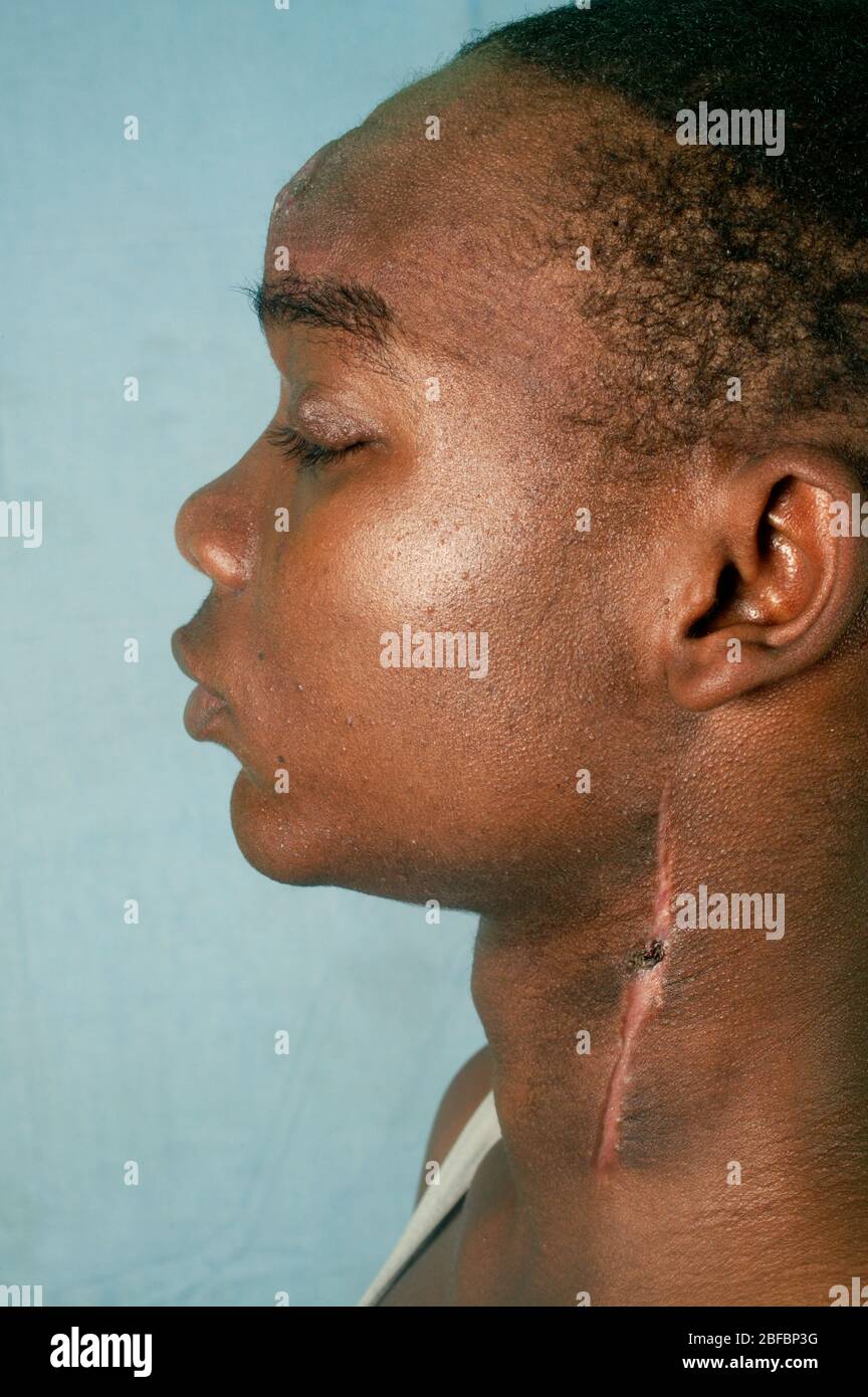 Side view of 19 year old boy with arteriovenous malformation (AVM). AVM ...