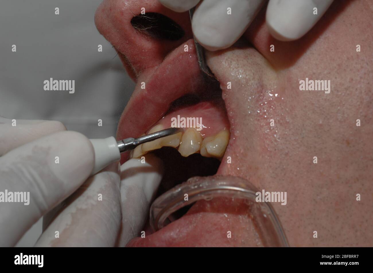 A dentist uses a dental scraper along with a dental mirror to examine