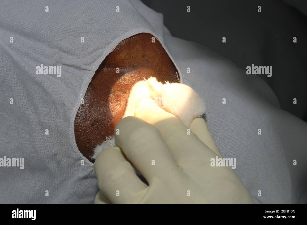 Swabbed The site is swabbed to stop any bleeding Stock Photo - Alamy