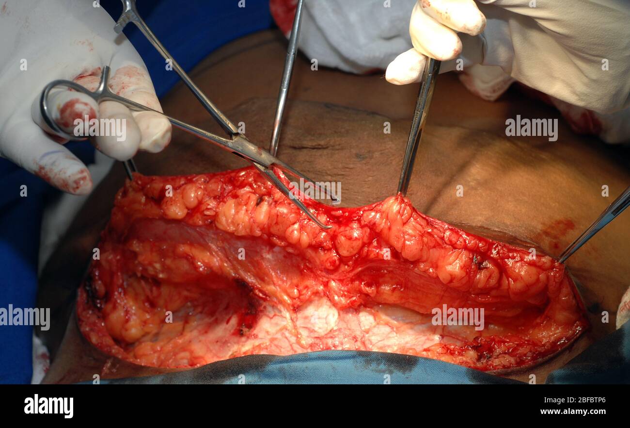 Abdominoplasty surgery hi-res stock photography and images - Alamy