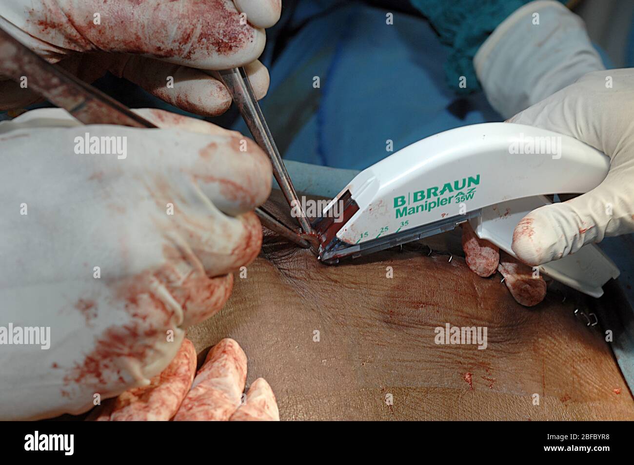 Surgical staples hires stock photography and images Alamy
