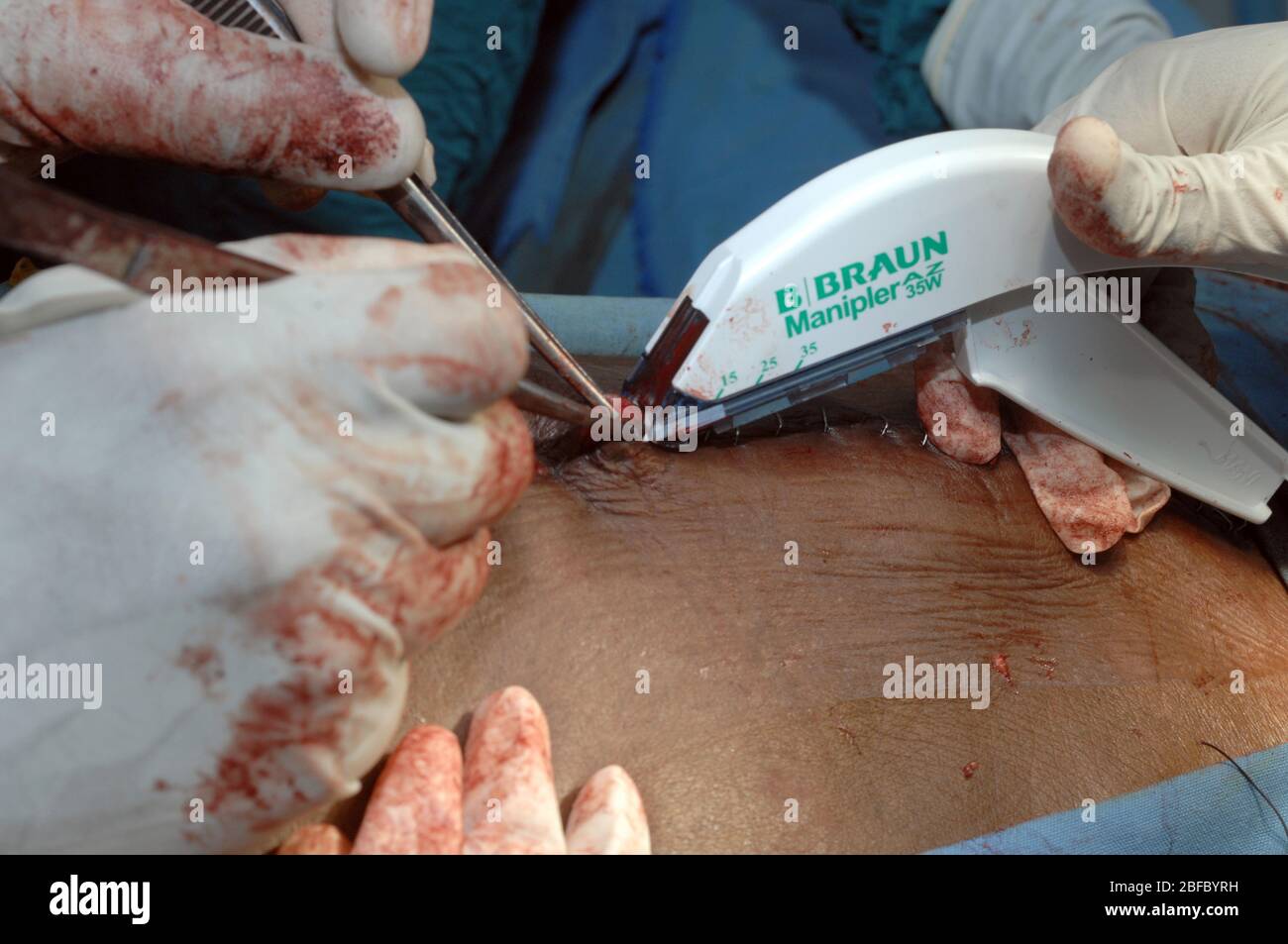 Surgical staples hires stock photography and images Alamy