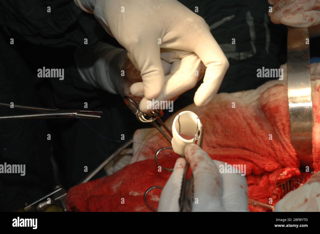 Surgeons suture a dacron graft to the aorta to repair an ascending