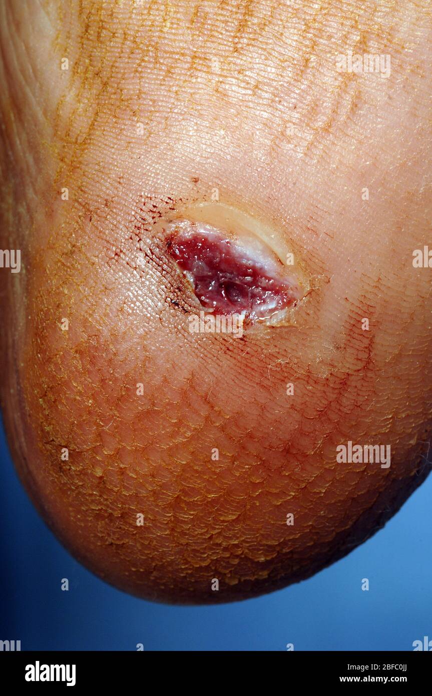 Pus abscess hi-res stock photography and images - Page 2 - Alamy
