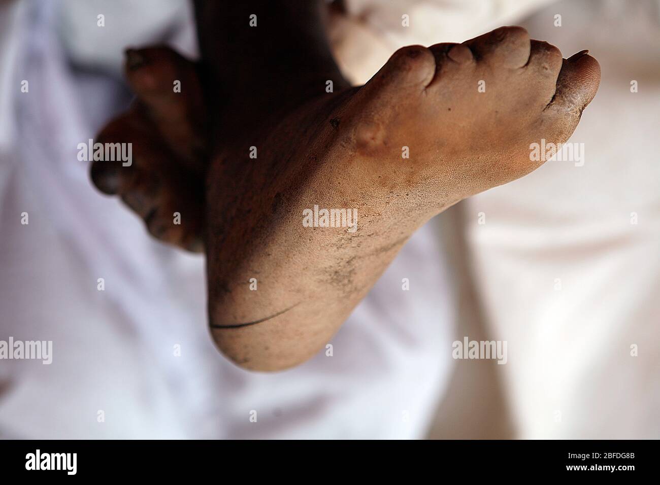 The feet of a young man suffering from leprosy. Leprosy is a chronic inflammatory disease caused by mycobacterium leprae. Leprosy damages the nerves, Stock Photo