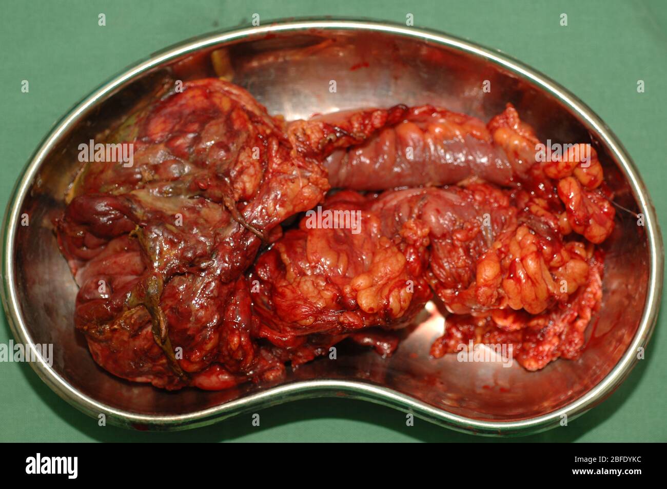 Surgeons work to remove the caecum and ascending colon of a patient following a gunshot wound. Stock Photo