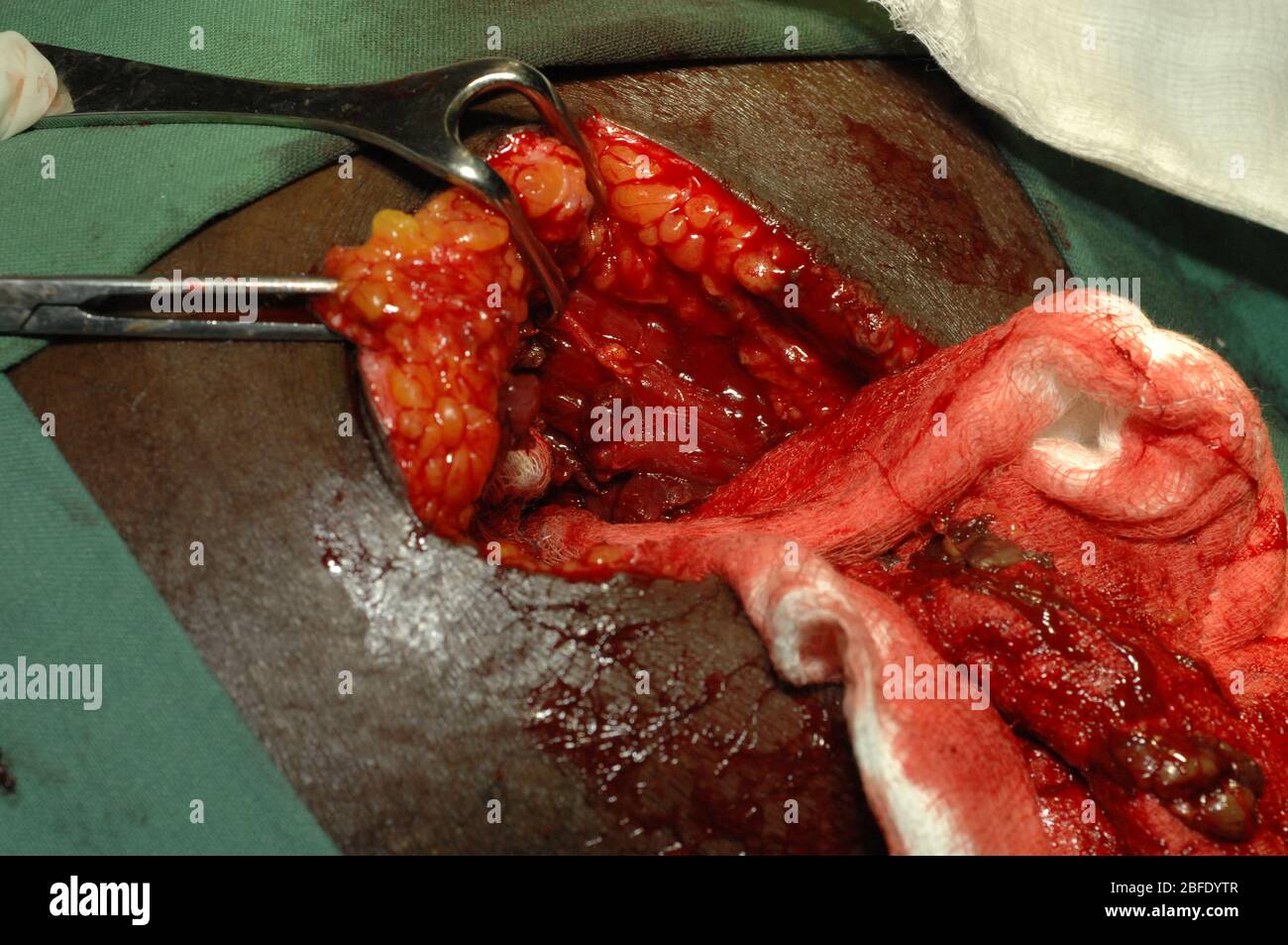 Close up of a doctor cleaning and treating an infected sepis wound. The wound has also become gangrene. Sepis is an extremly serious medical condition Stock Photo