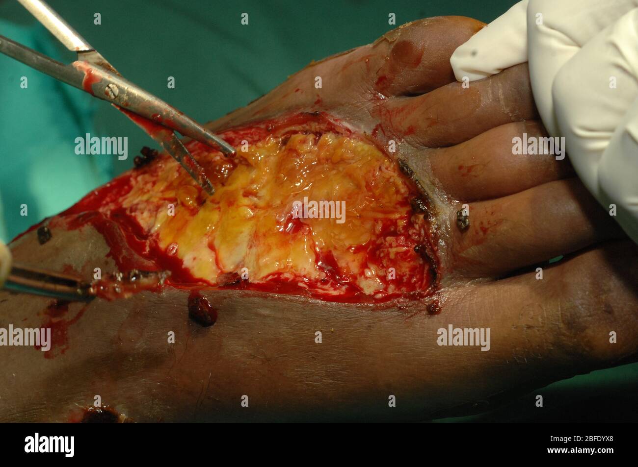 Close up of a doctor cleaning and treating an infected sepis wound. The wound has also become gangrene. Sepis is an extremly serious medical condition Stock Photo