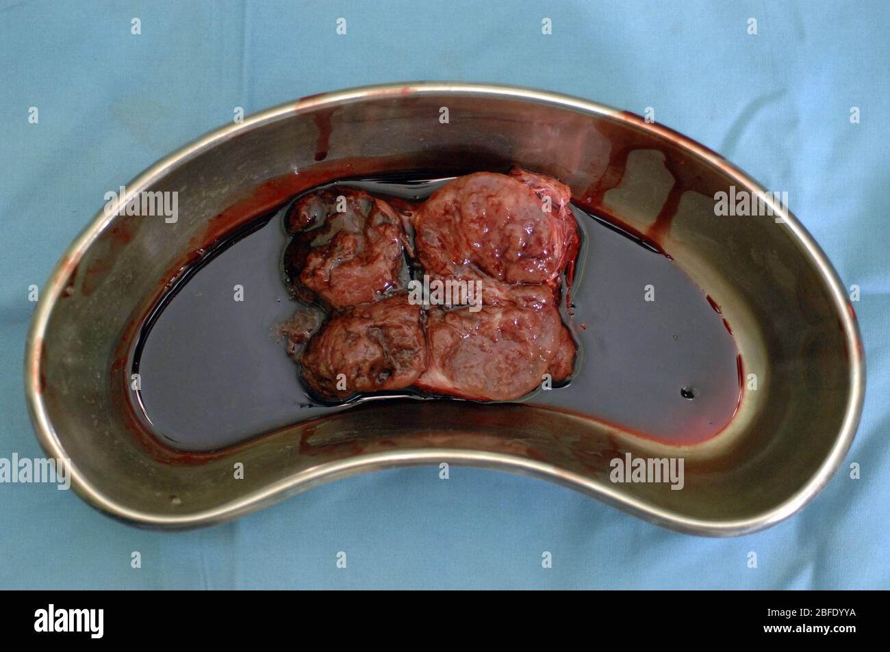 Close-up of an excised goitre (enlarged thyroid gland in a silver kidney dish). Stock Photo