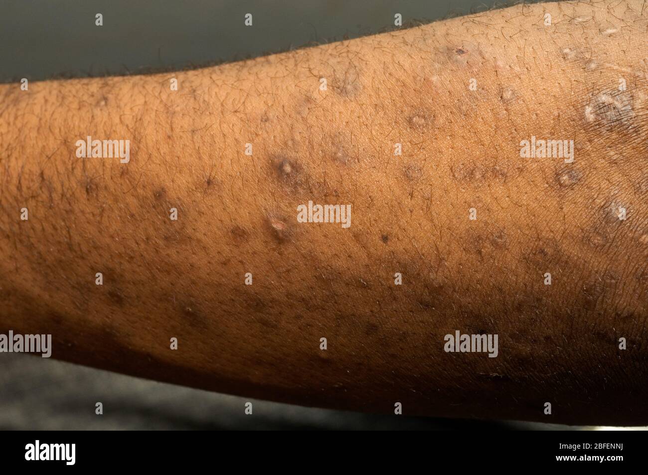 Psoriasis arm hi-res stock photography and images - Alamy