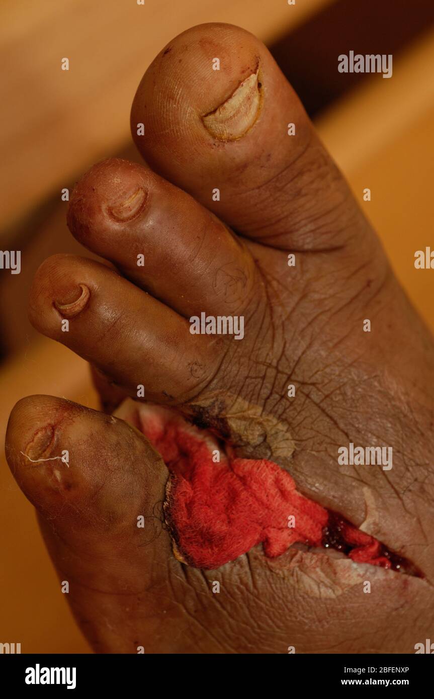 The left foot of a patient who has had to endure amputation of their fourth toe in order to save the rest of her foot from an infection. An example of Stock Photo
