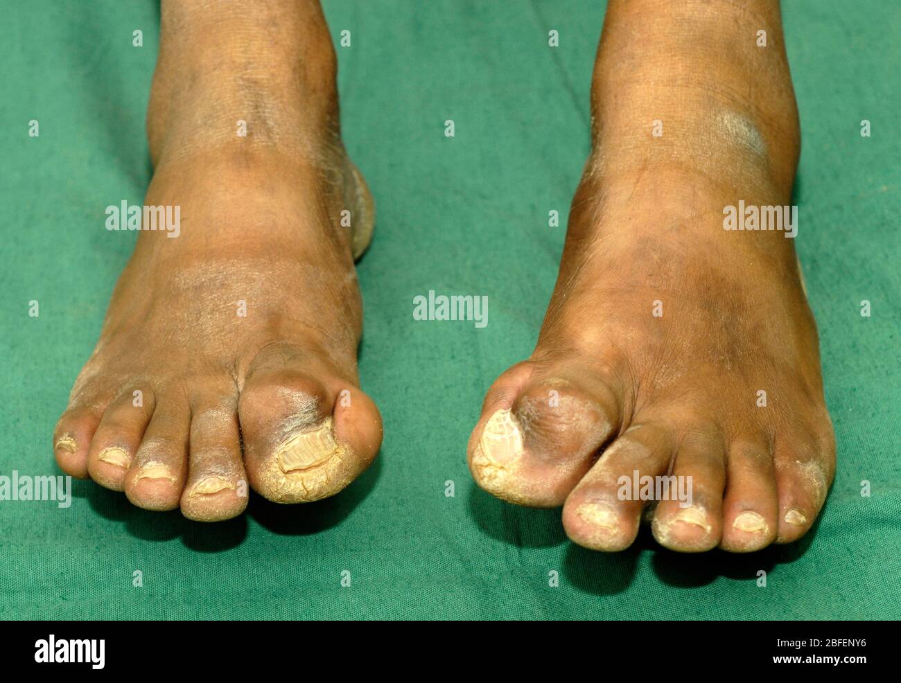 Patient has deformed big toes. Cause unknown Stock Photo - Alamy