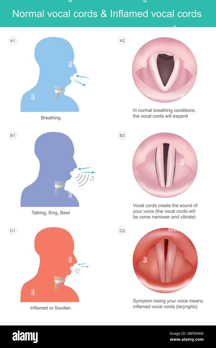 Normal vocal cords & Inflamed vocal cords. The vocal cords create the sound of your voice for speaking or sing, if losing your voice means vocal cords Stock Vector