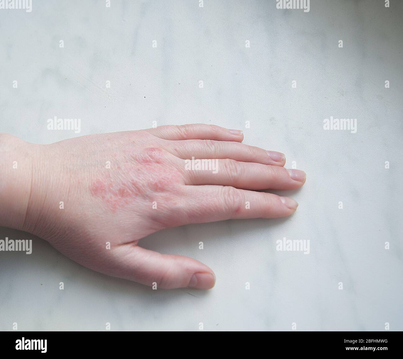 Hand Closeup Skin Disease Psoriasis Stock Photo Alamy