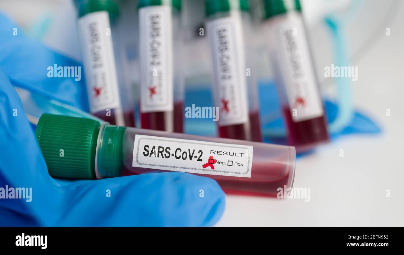 Negative SARSCoV2 sample in test tube. Lab equipment in COVID19
