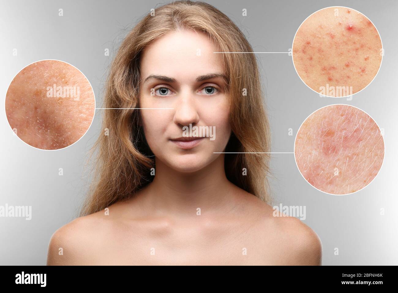 Acne and skin care concept. Young woman before and after cosmetic