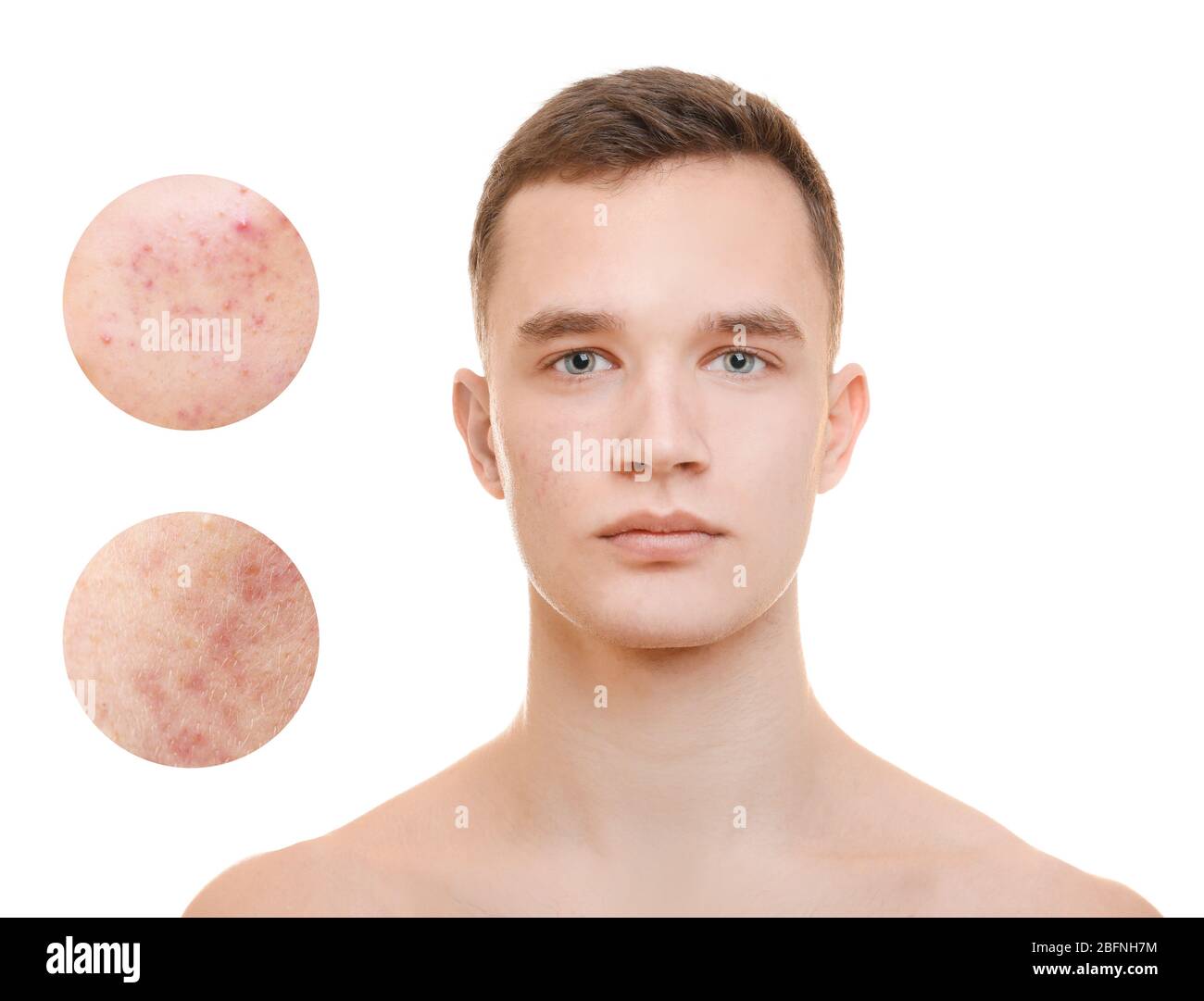 Acne and skin care concept. Young man before and after cosmetic ...