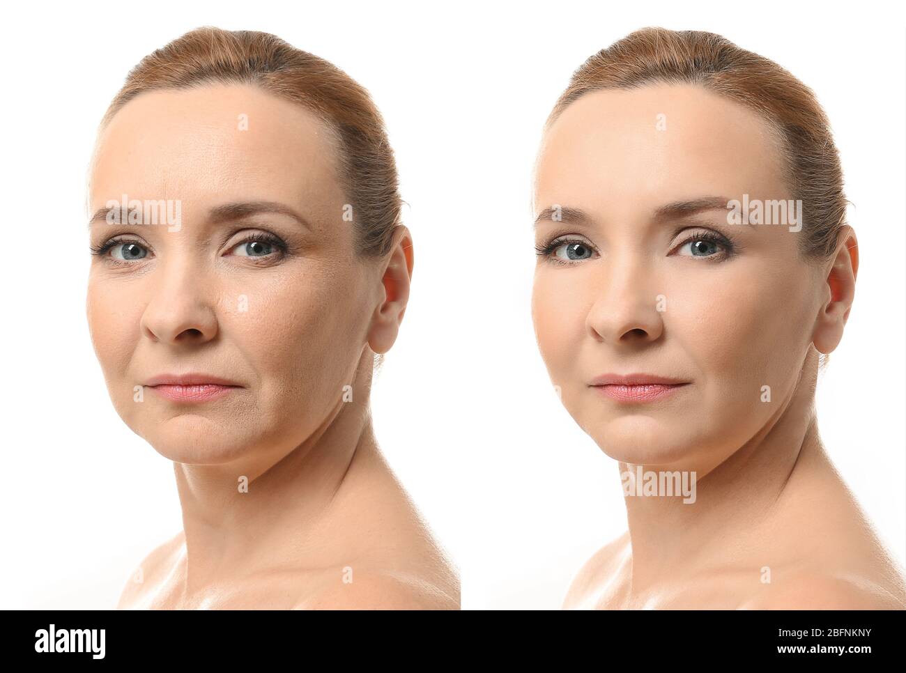 mature before after.com Mature woman before and after biorevitalization procedure on white  background Stock Photo - Alamy