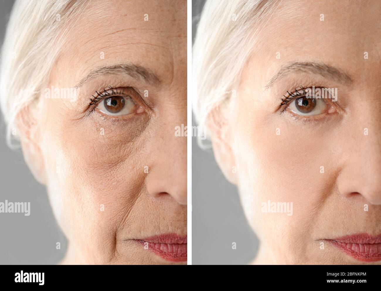 Senior woman before and after biorevitalization procedure, closeup