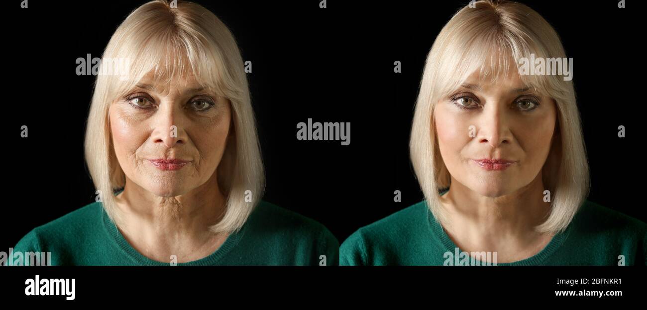 mature before after Mature woman before and after biorevitalization procedure on black  background Stock Photo - Alamy