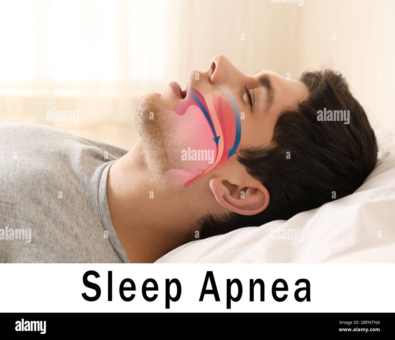 Sleep apnea mouth hires stock photography and images Alamy