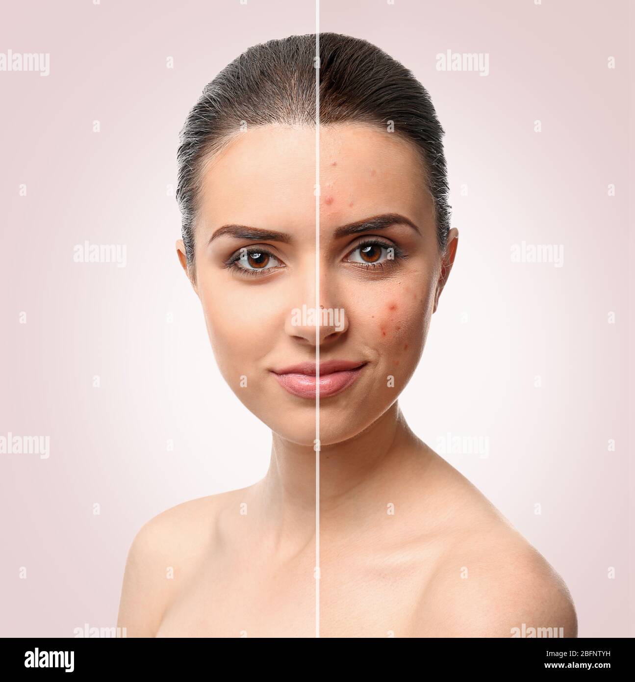 Woman face before and after acne treatment procedure. Skin care concept