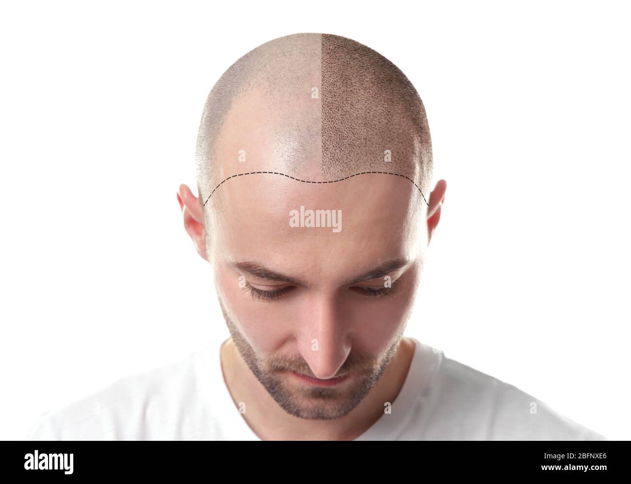 Man before and after hair loss treatment on white background Stock