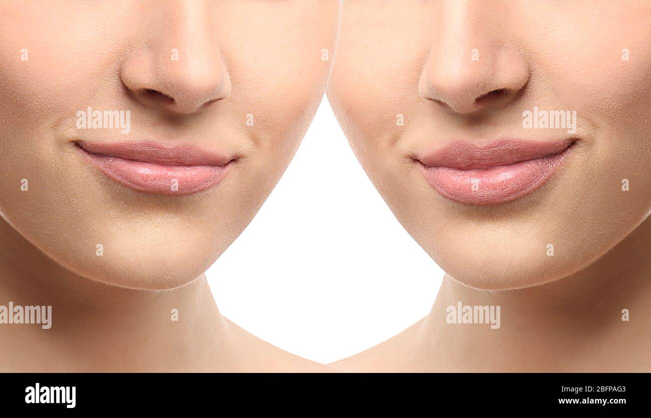 Woman lips before and after cosmetic procedure. Plastic surgery concept