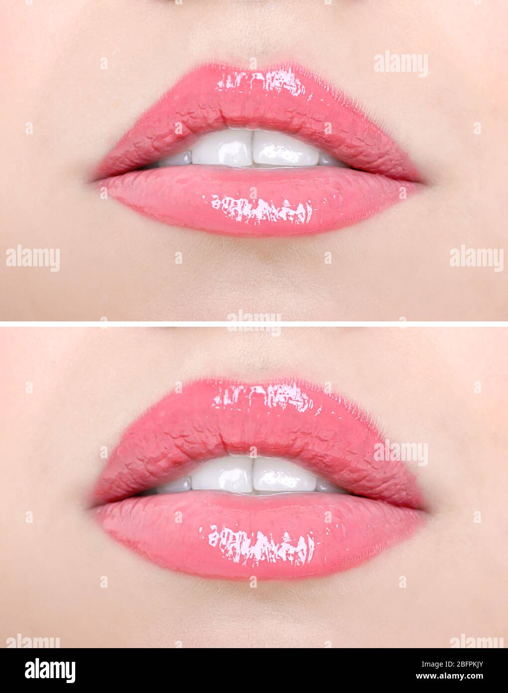 Female lips before and after augmentation procedure. Beauty concept ...