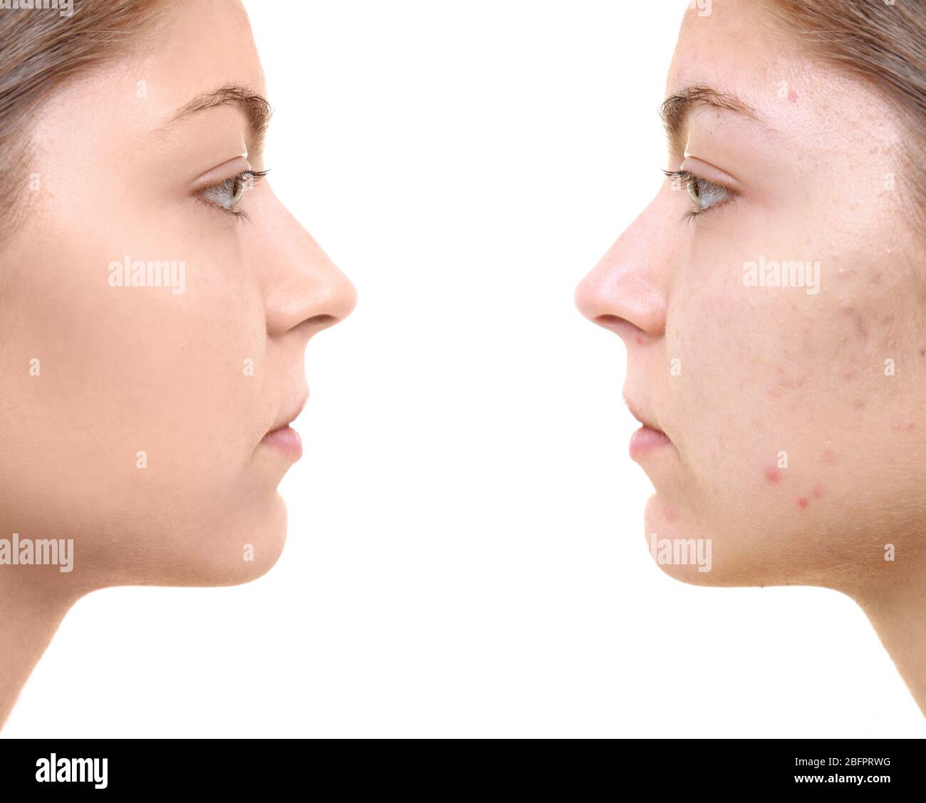Young woman before and after acne treatment on white background. Skin ...