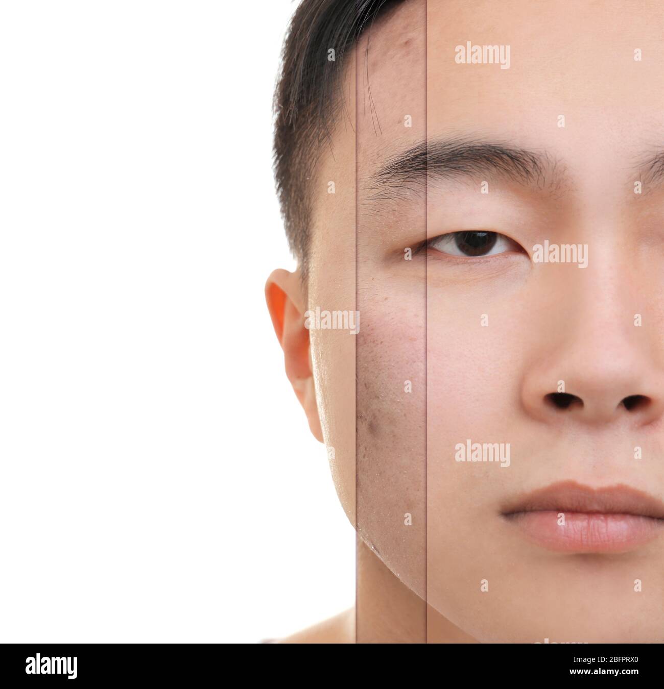 Young man before and after acne treatment on white background. Skin ...
