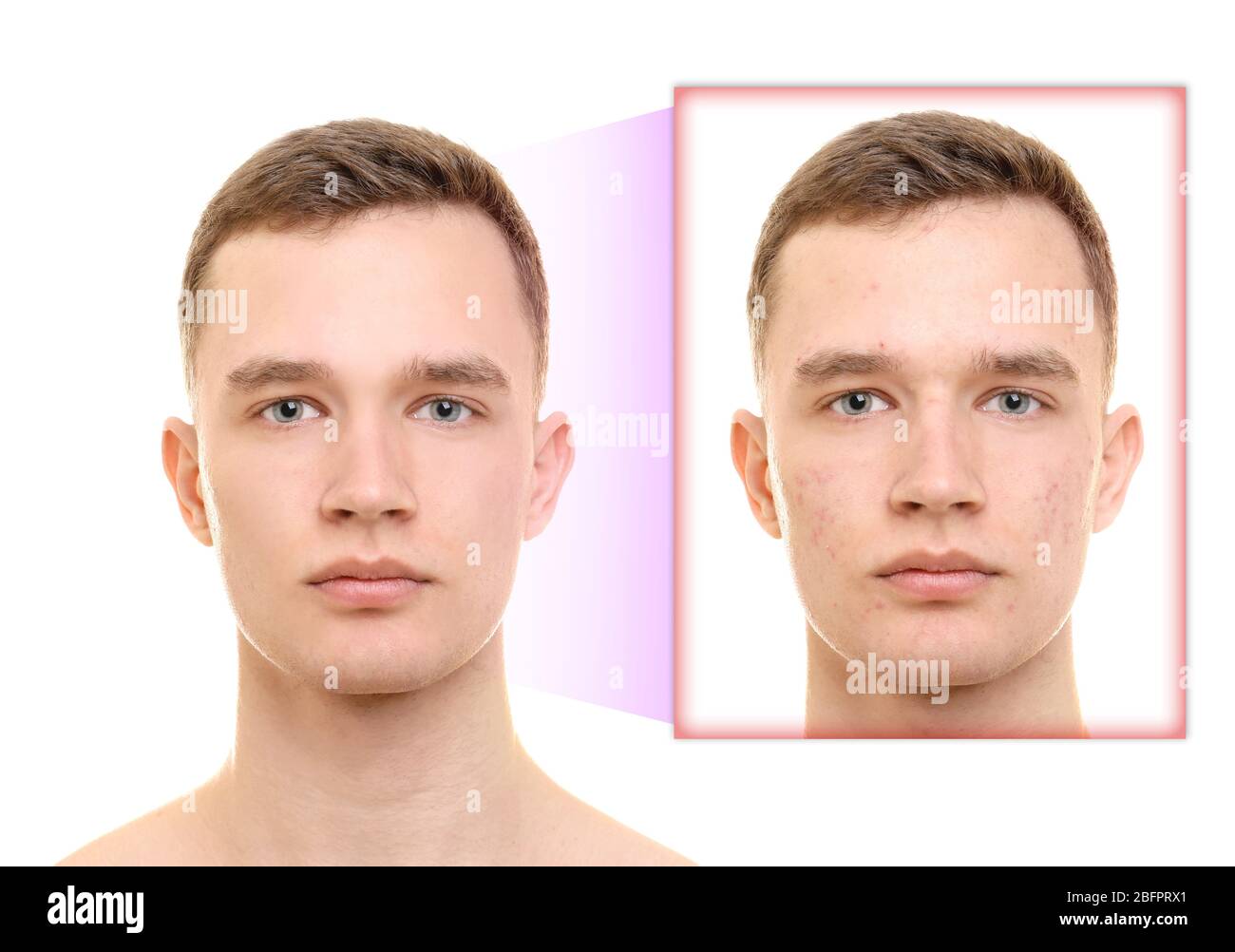 Young man before and after acne treatment on white background. Skin ...