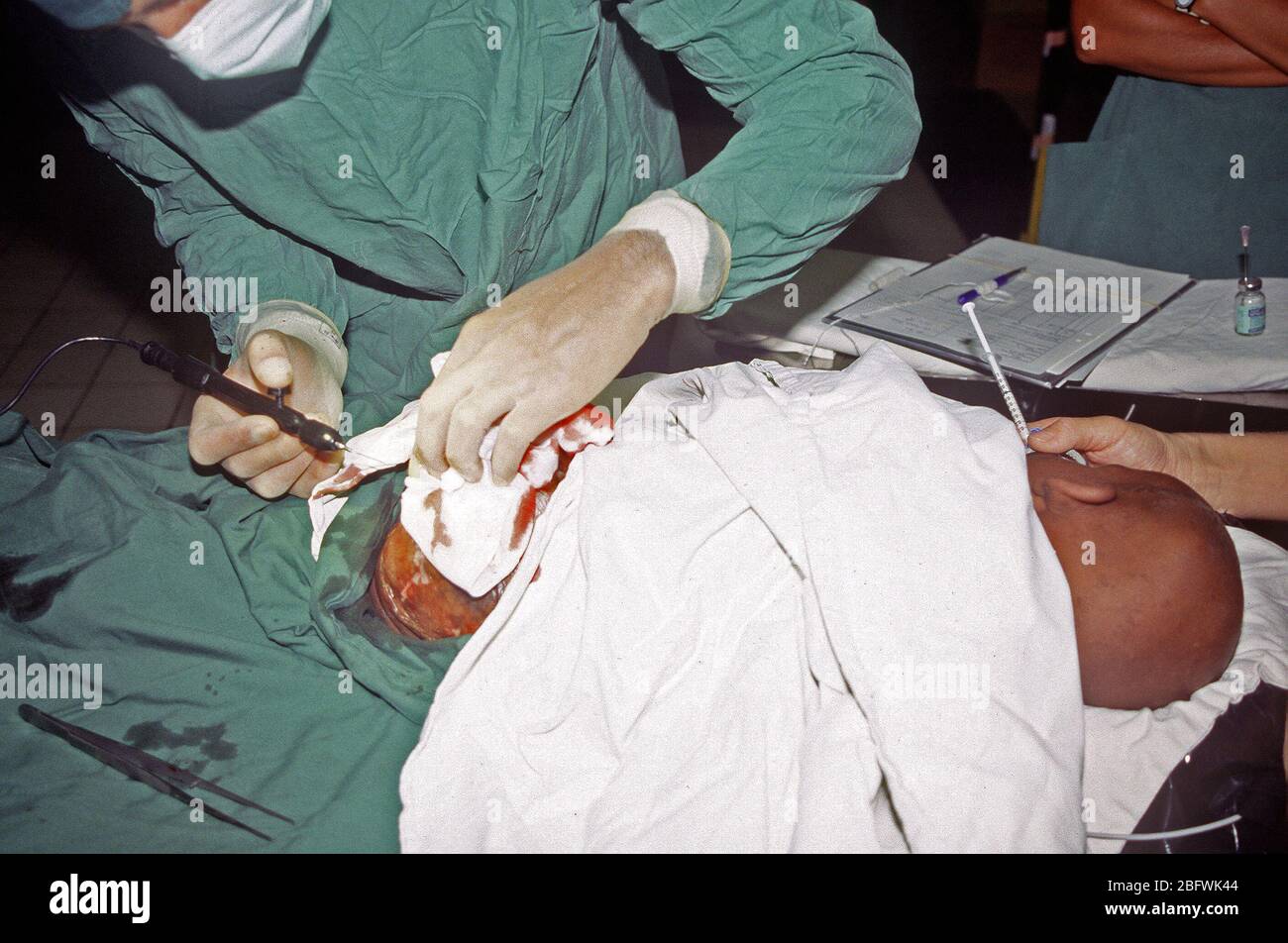 1993 - A doctor performs a skin graph on 2 1/2 year old Ali Salad Roble in the operating room of the Swedish hospital. (Mogadishu Somalia) Stock Photo