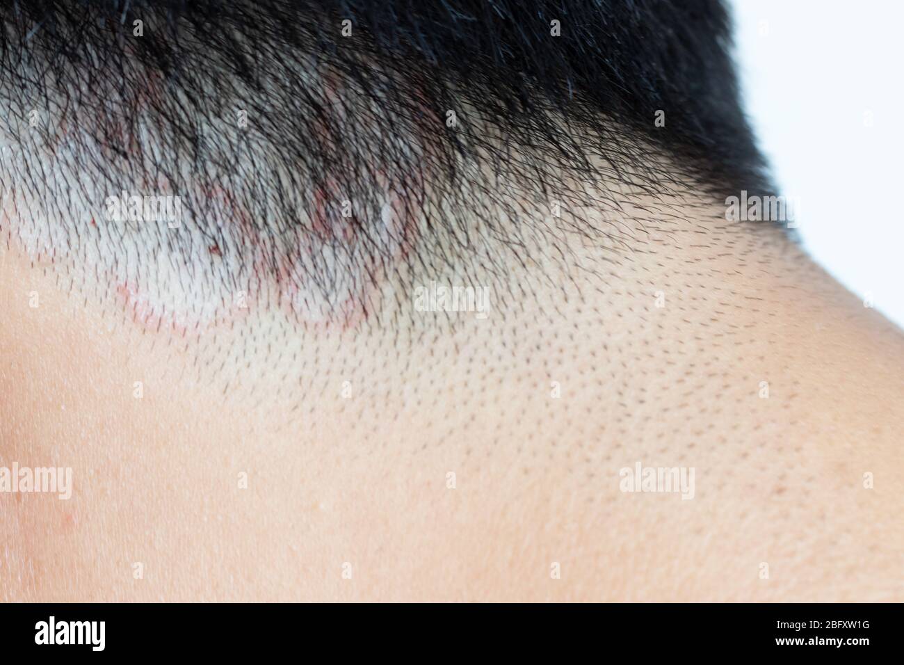 Closed up of ringworm (tinea) on head of asian man (Dermatitis) Stock Photo
