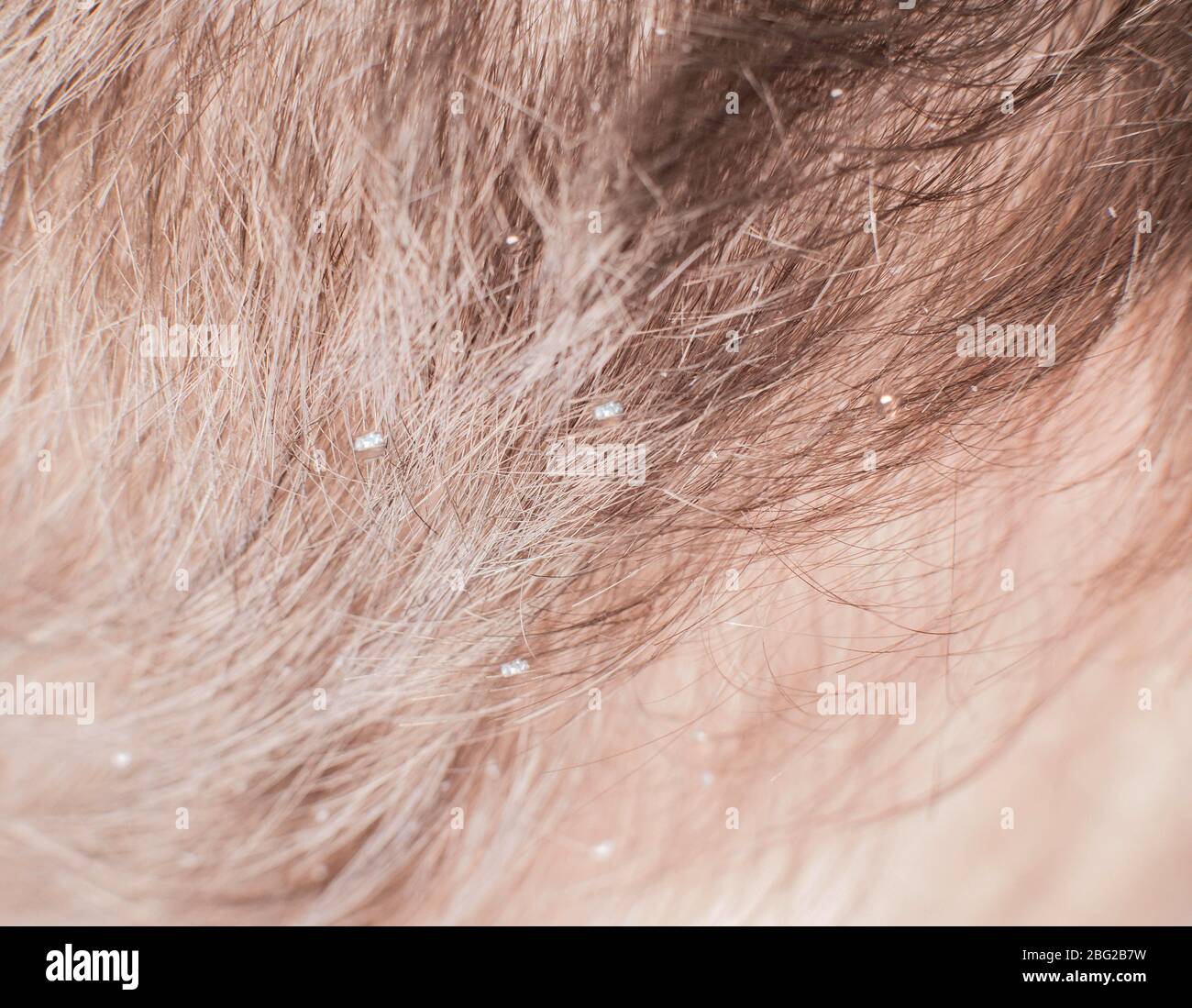 Dandruff scales in brown hair in humans. The concept of getting rid of